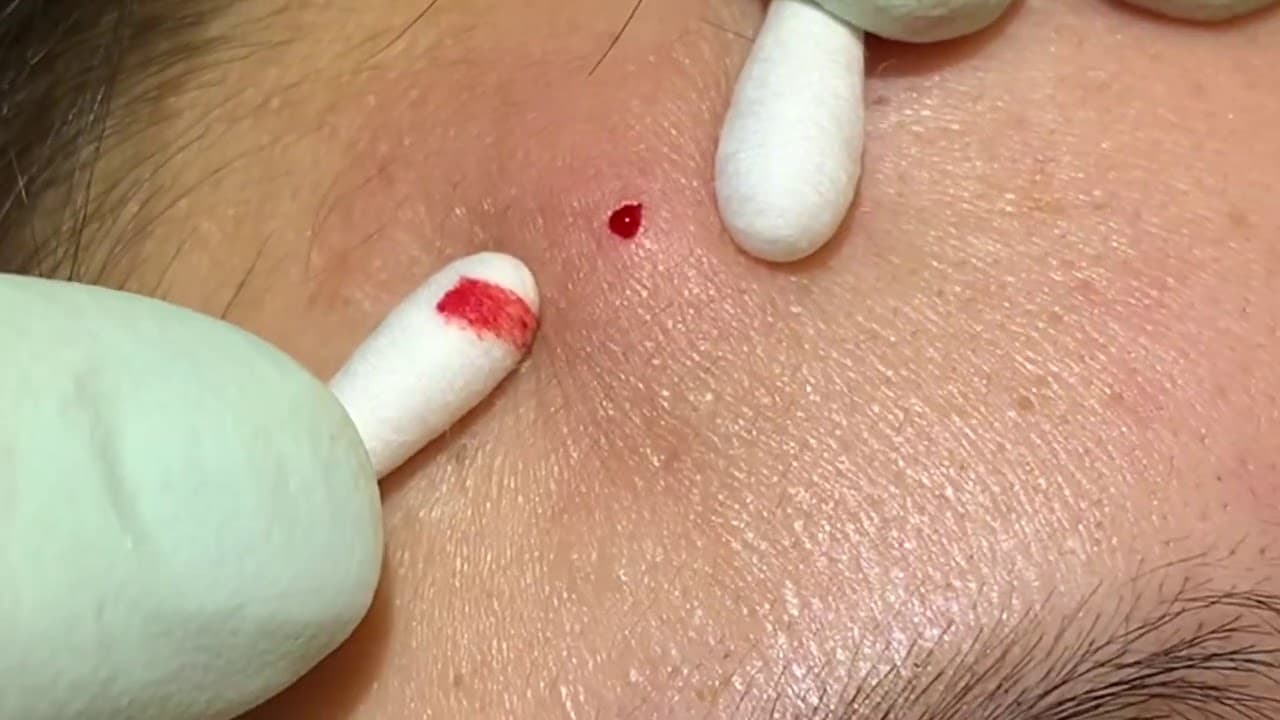 Your new Fave acne Extractions#4. 20 minutes of just the pop. Ear extractions, this one has it all.